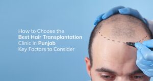 How to Choose the Best Hair Transplantation Clinic in Punjab | Expert Guide